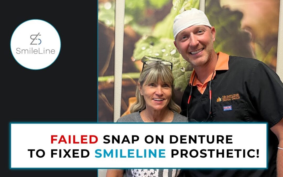 SmileLine Ep. 8 – Patient Converts From a Failed Snap on Denture to a Fixed SmileLine Prosthetic