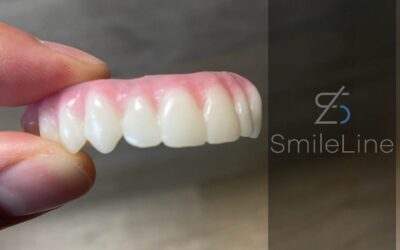 Dentures vs. Permanent Full-Mouth Dental Implants